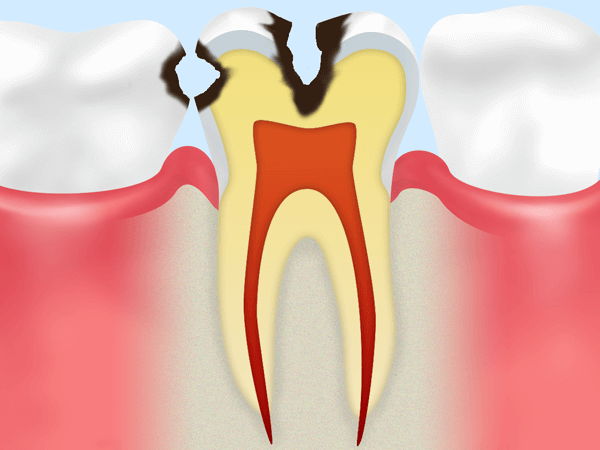 象牙質にまで達した虫歯（C2）