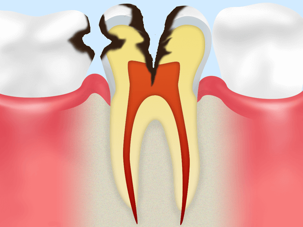 歯の神経にまで達した虫歯（C3）