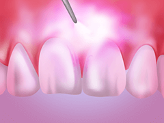 レーザーによる痛みの少ない虫歯治療