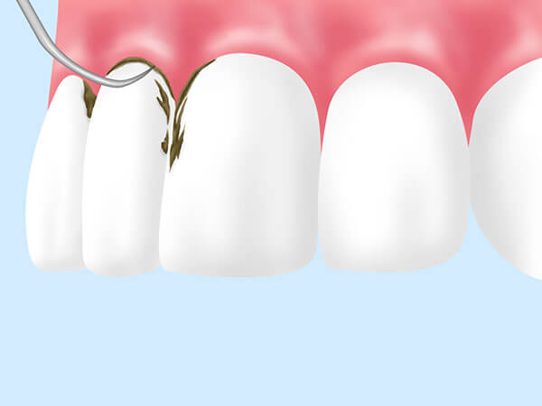 スケーリング：歯の表面についた歯石や汚れを落としていきます。